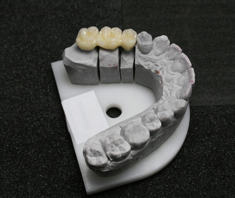 Corone zirconio ceramica: caratteristiche e vantaggi