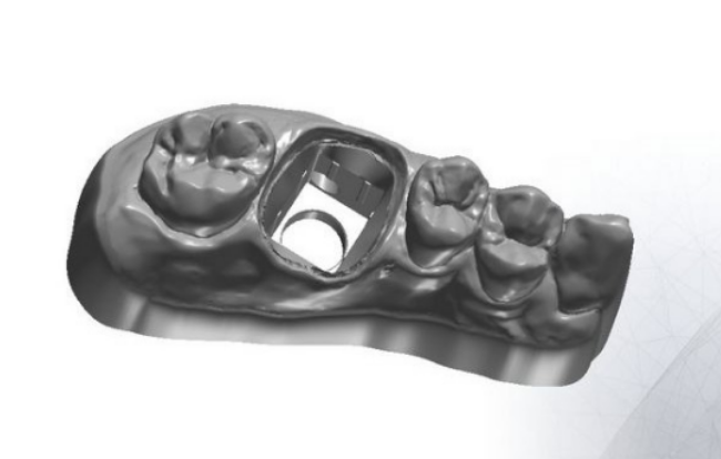 digital denture