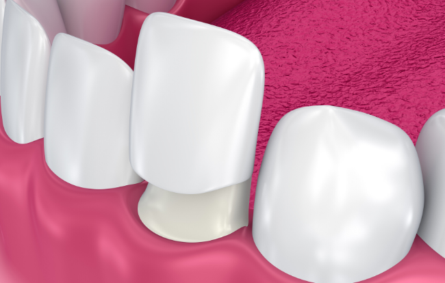 Veneers denti: faccette dentali di alta qualità a prezzi contenuti